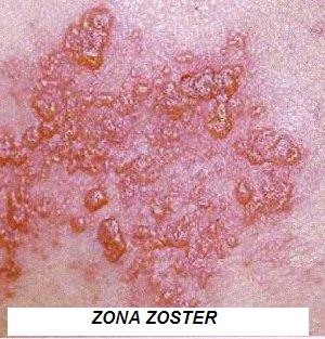 Zona zoster - herpesul zoster